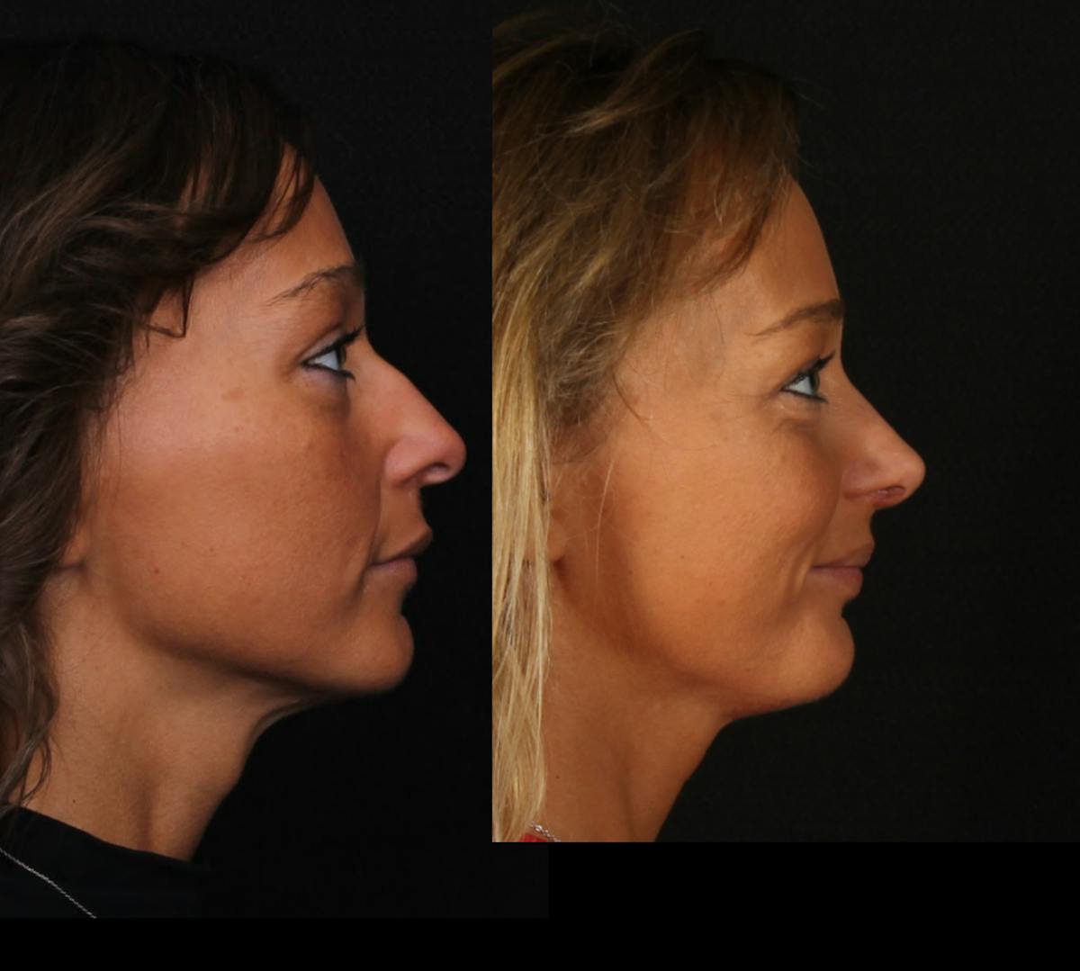 Rhinoplasty Female Before & After Gallery - Patient 624732 - Image 1