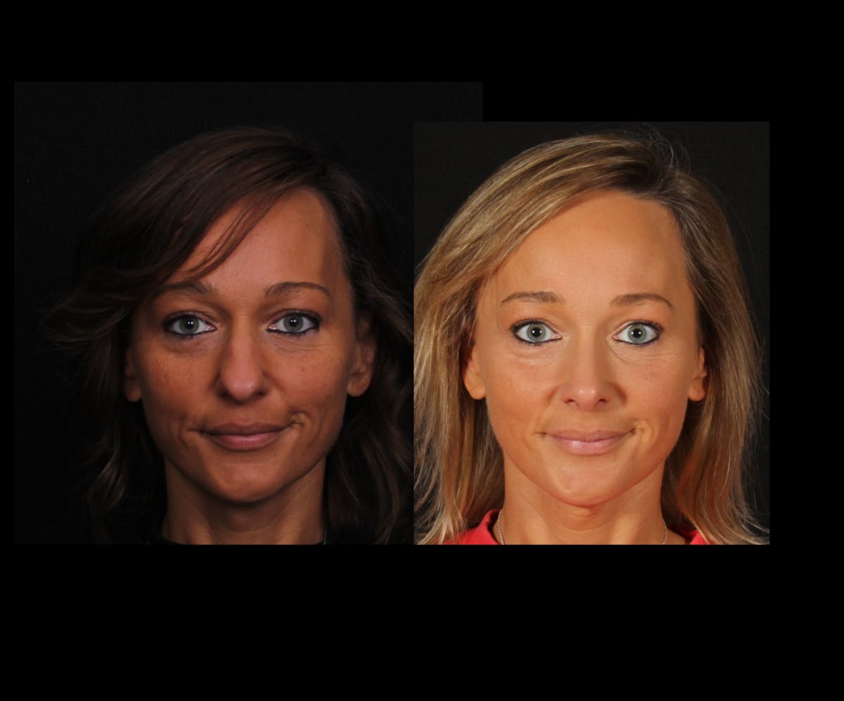 Rhinoplasty Female Before & After Gallery - Patient 624732 - Image 3
