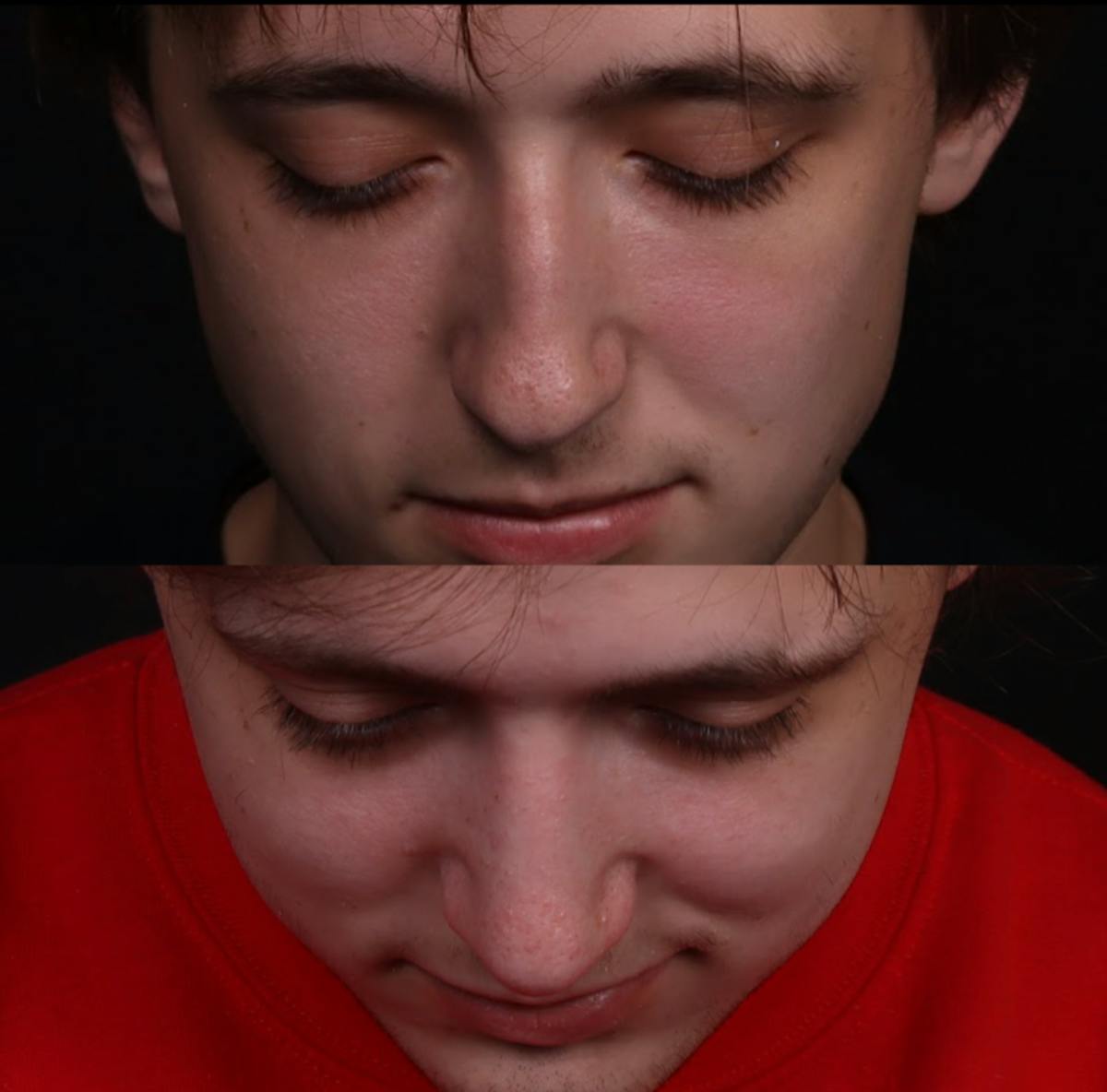 Rhinoplasty Male Before & After Gallery - Patient 537803 - Image 3