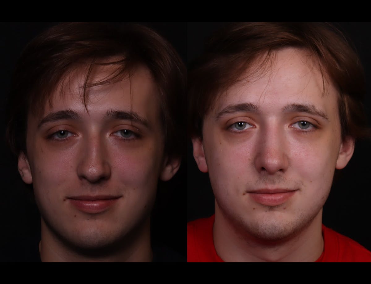 Rhinoplasty Male Before & After Gallery - Patient 537803 - Image 2