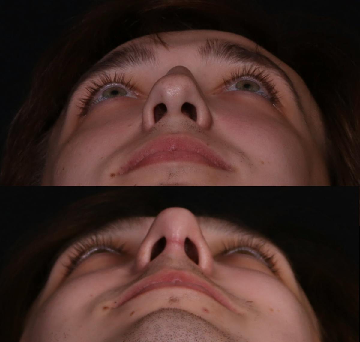Rhinoplasty Male Before & After Gallery - Patient 537803 - Image 4