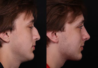 Rhinoplasty Male Before & After Gallery - Patient 537803 - Image 1