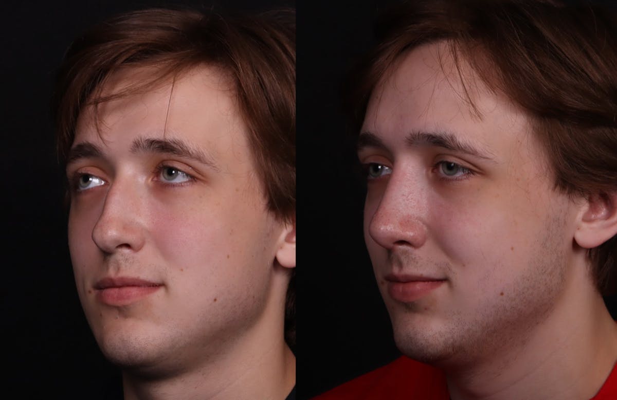 Rhinoplasty Male Before & After Gallery - Patient 537803 - Image 6