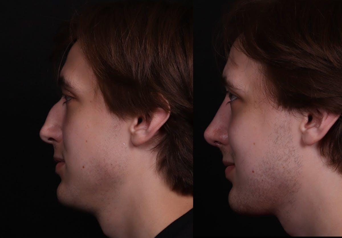 Rhinoplasty Male Before & After Gallery - Patient 537803 - Image 5