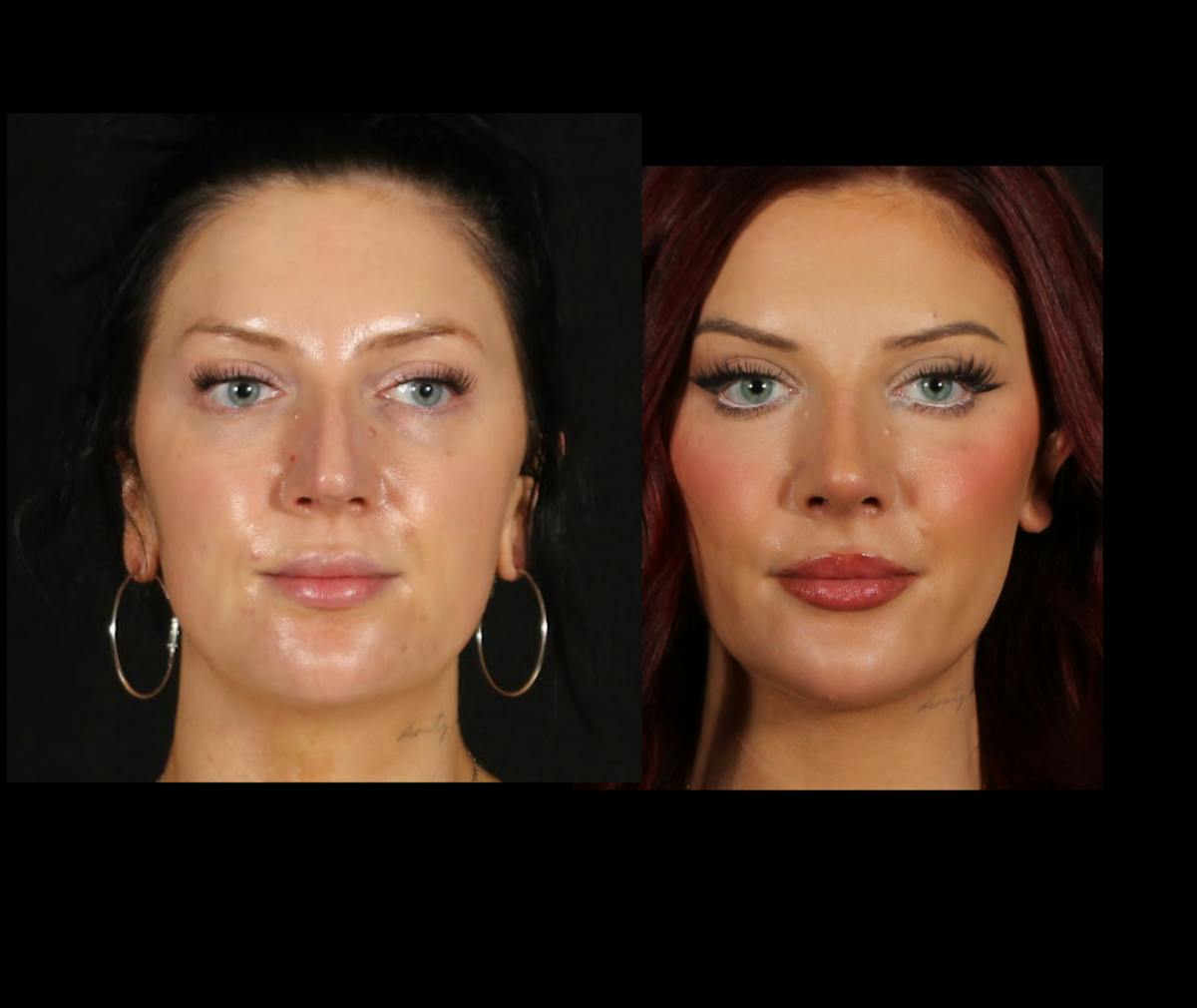 Rhinoplasty Female Before & After Gallery - Patient 228382 - Image 3