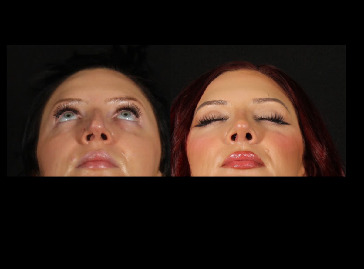 Rhinoplasty Female Before & After Gallery - Patient 228382 - Image 5