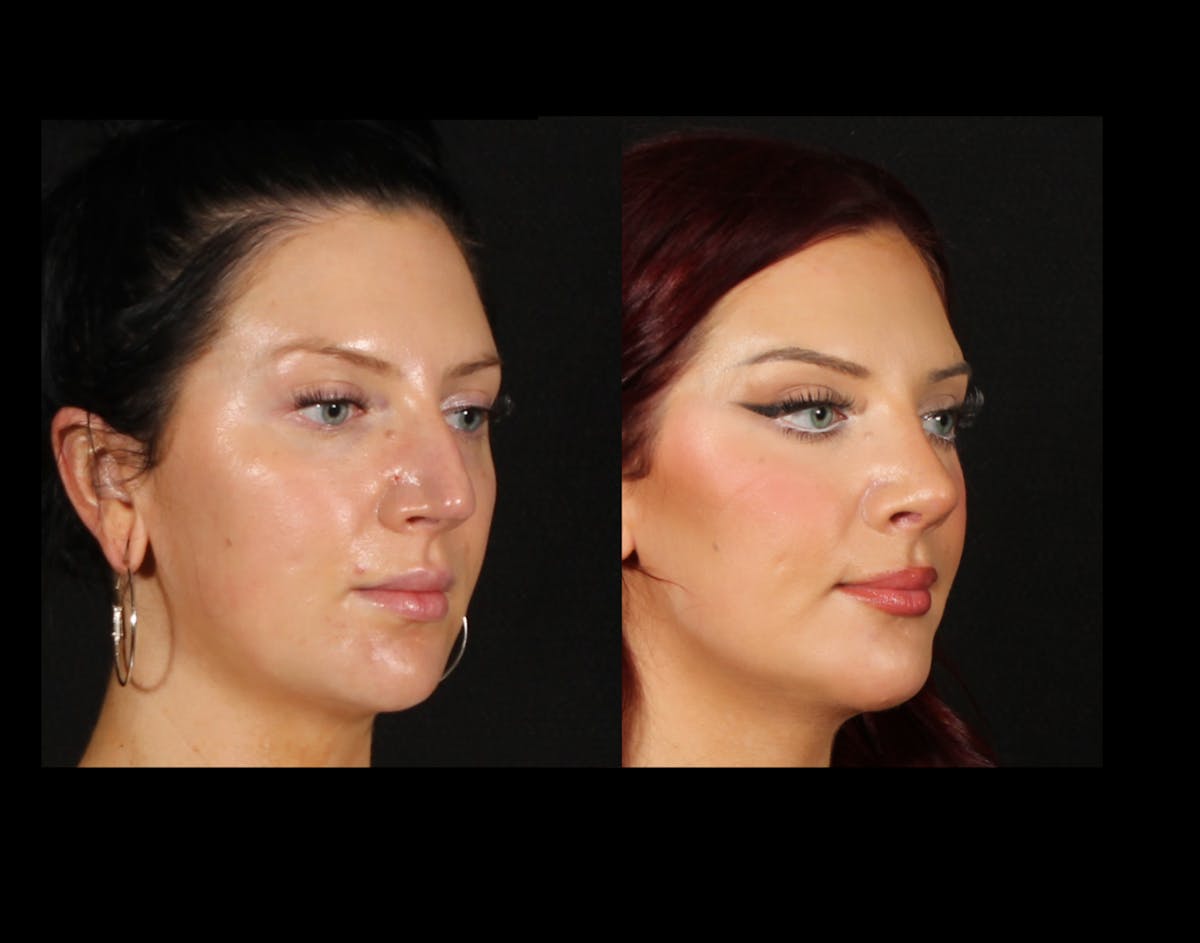 Rhinoplasty Female Before & After Gallery - Patient 228382 - Image 2