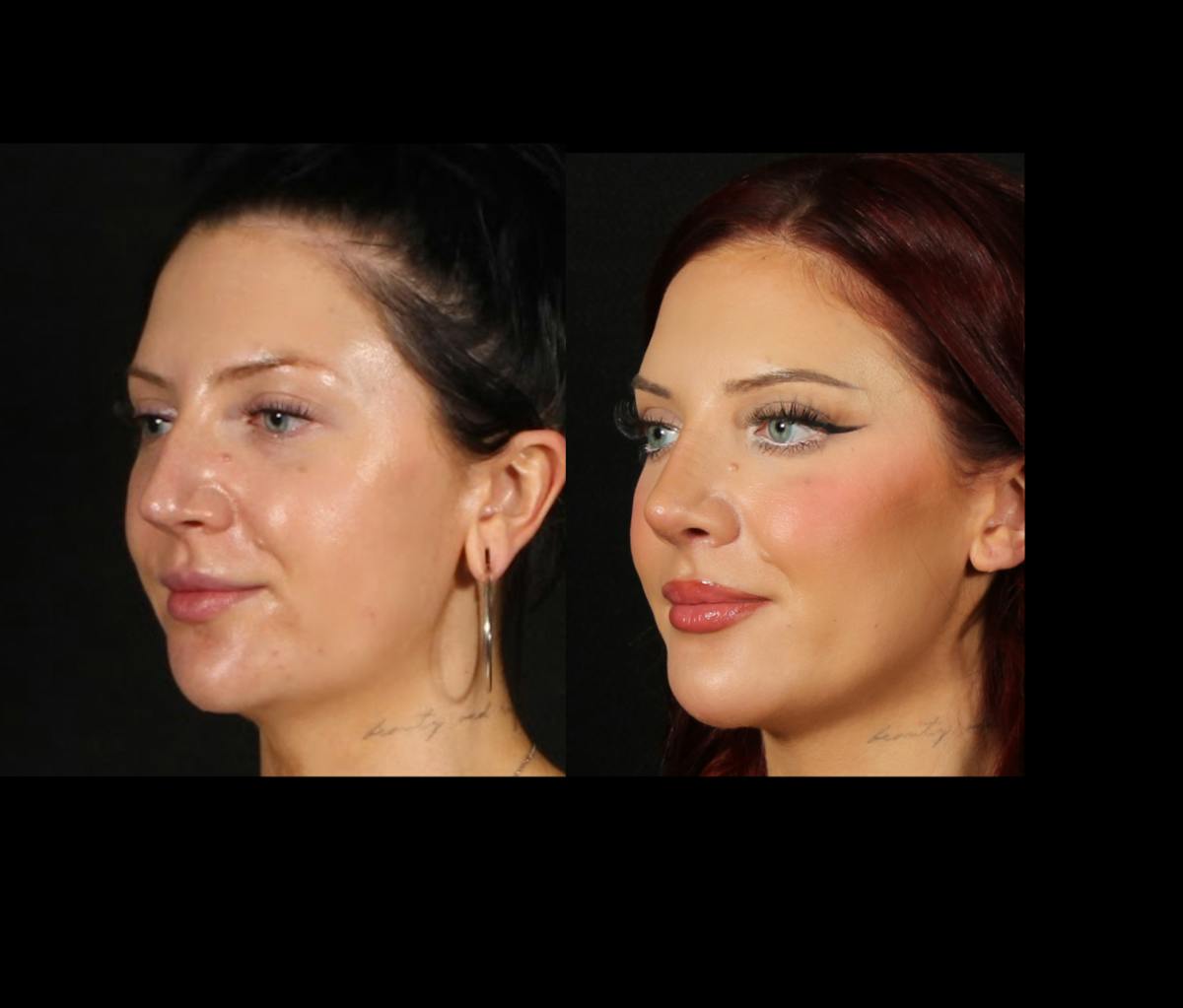 Rhinoplasty Female Before & After Gallery - Patient 228382 - Image 6