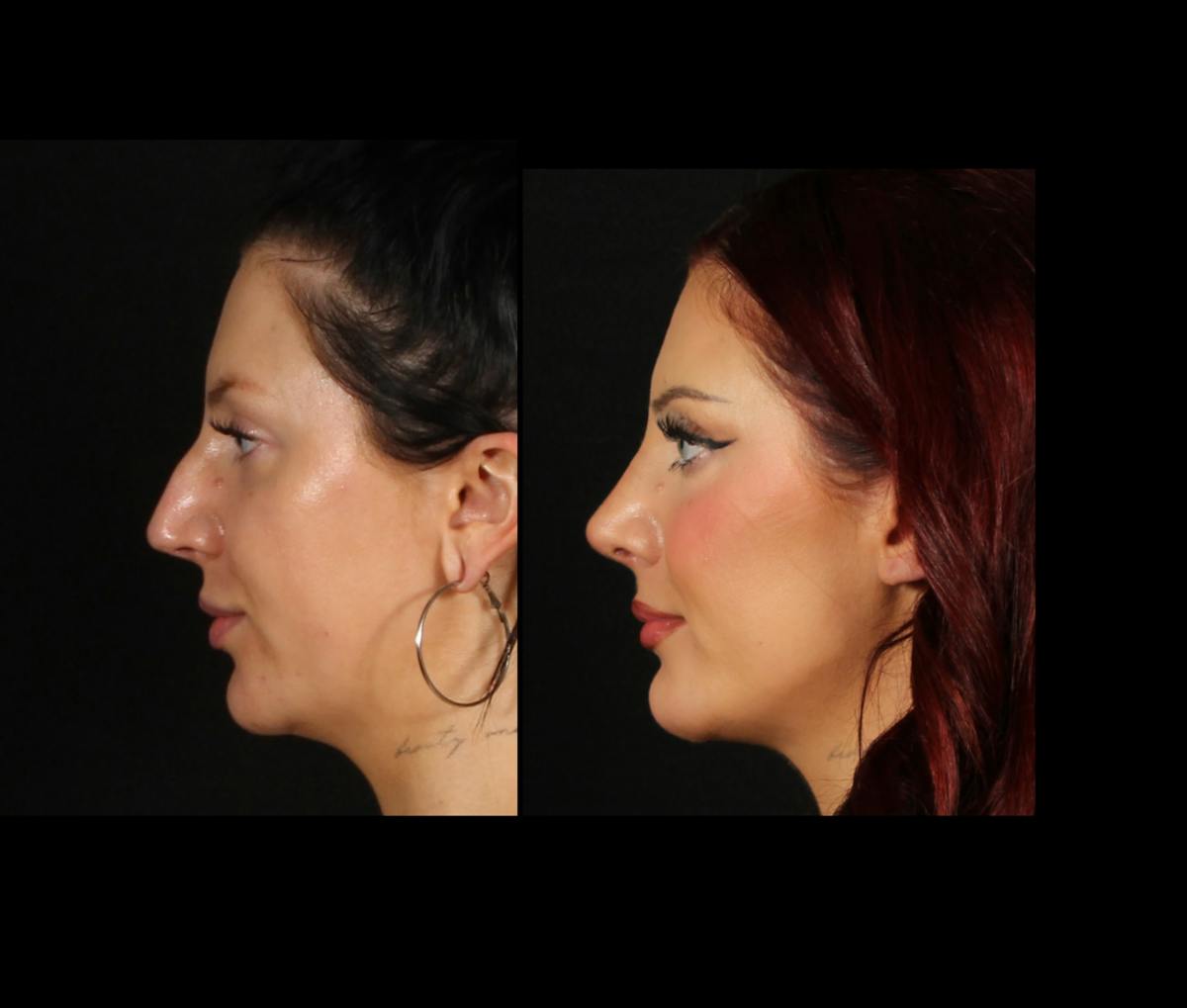 Rhinoplasty Female Before & After Gallery - Patient 228382 - Image 7
