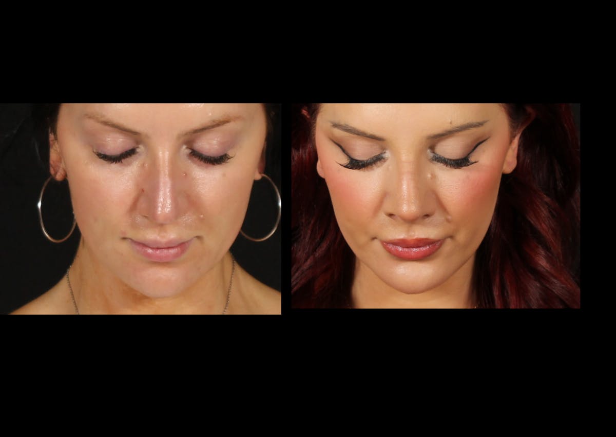 Rhinoplasty Female Before & After Gallery - Patient 228382 - Image 4