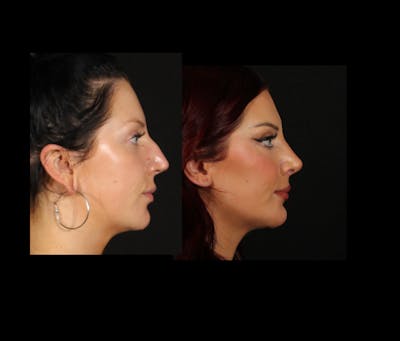 Rhinoplasty Female Before & After Gallery - Patient 228382 - Image 1