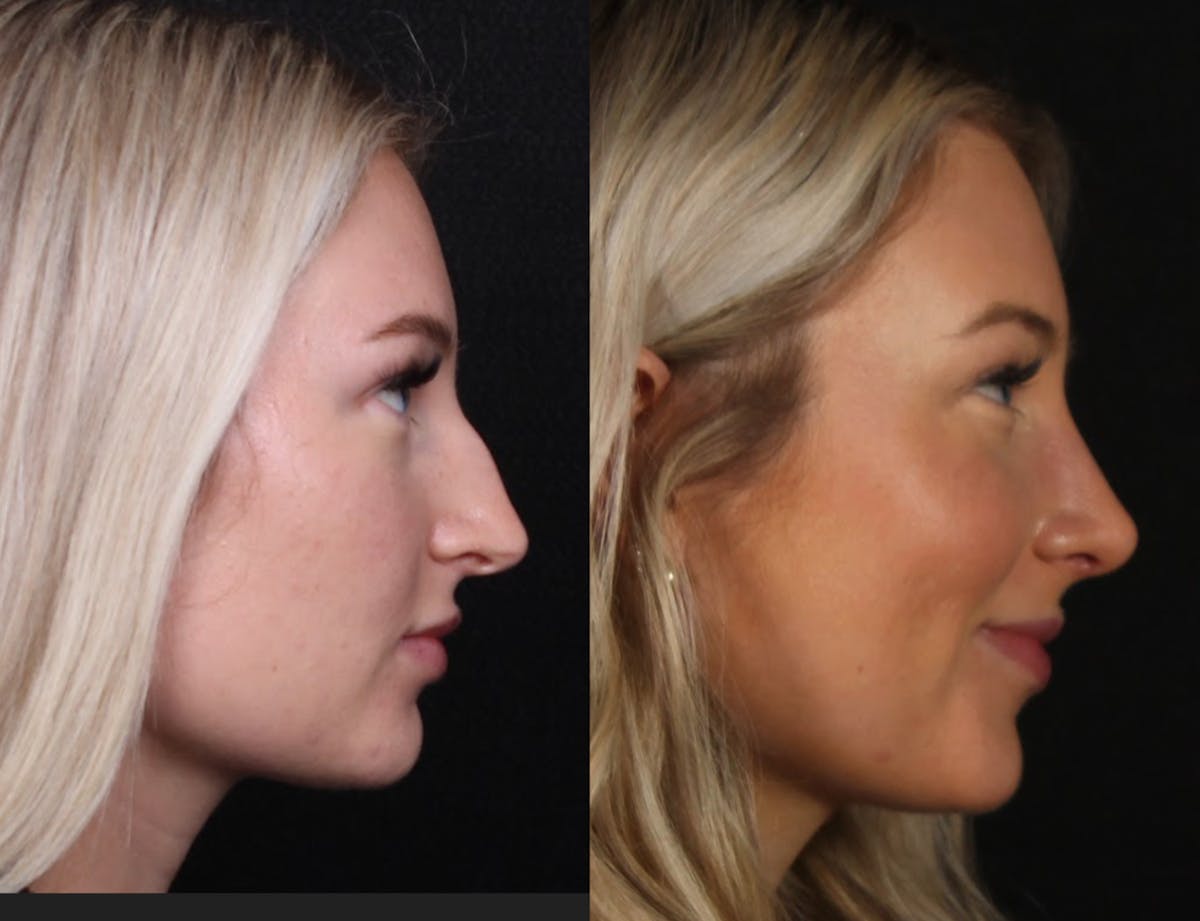 Rhinoplasty Female Before & After Gallery - Patient 134800 - Image 1