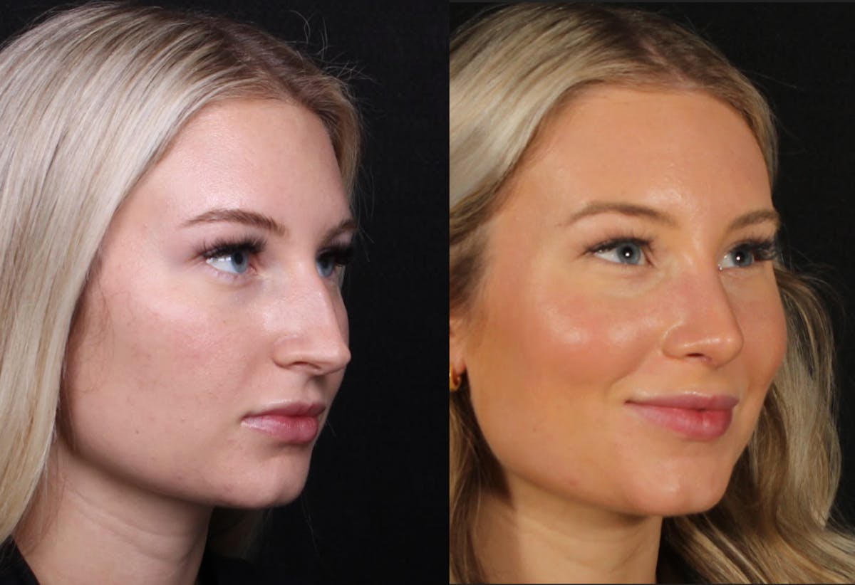 Rhinoplasty Female Before & After Gallery - Patient 134800 - Image 2