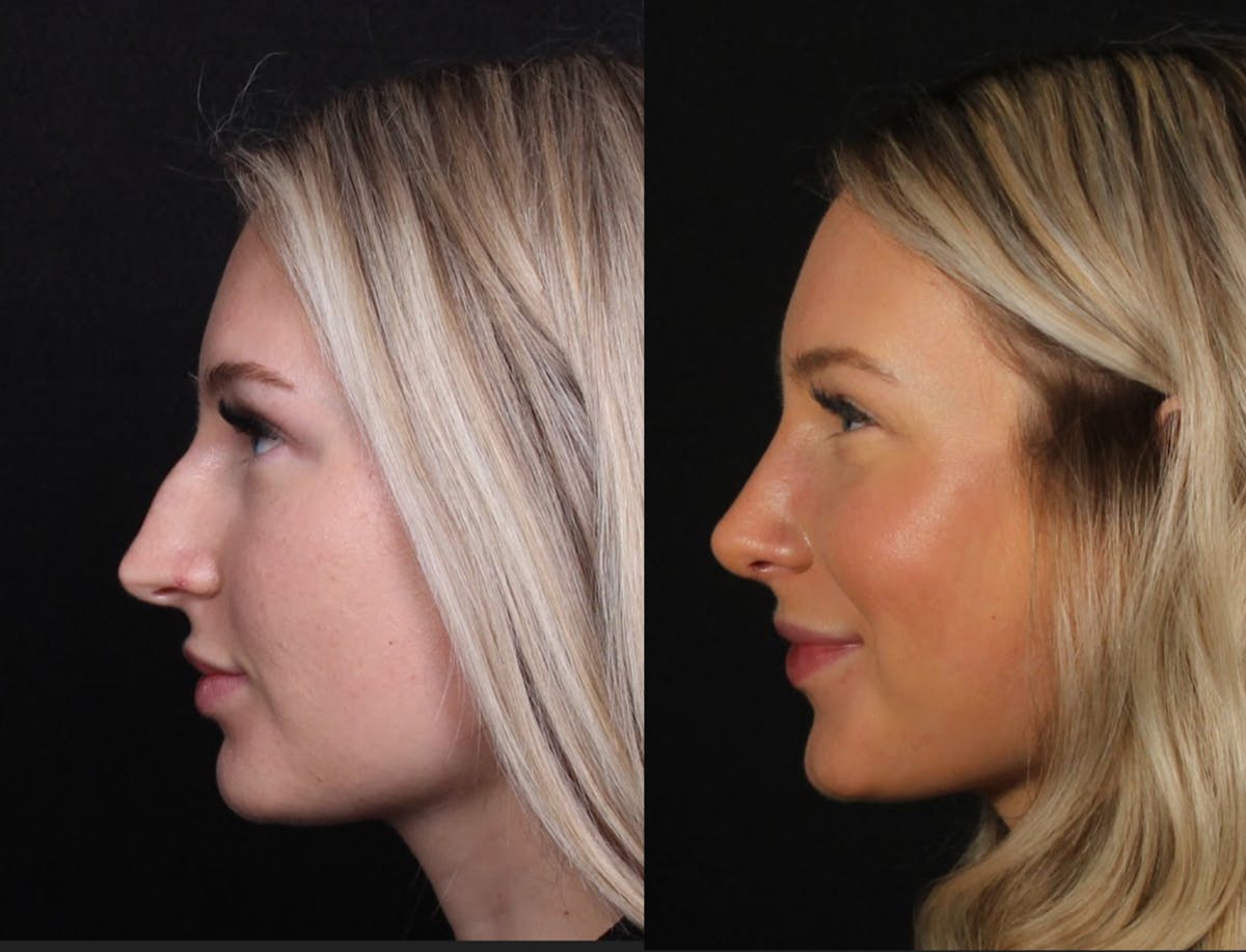 Rhinoplasty Female Before & After Gallery - Patient 134800 - Image 3