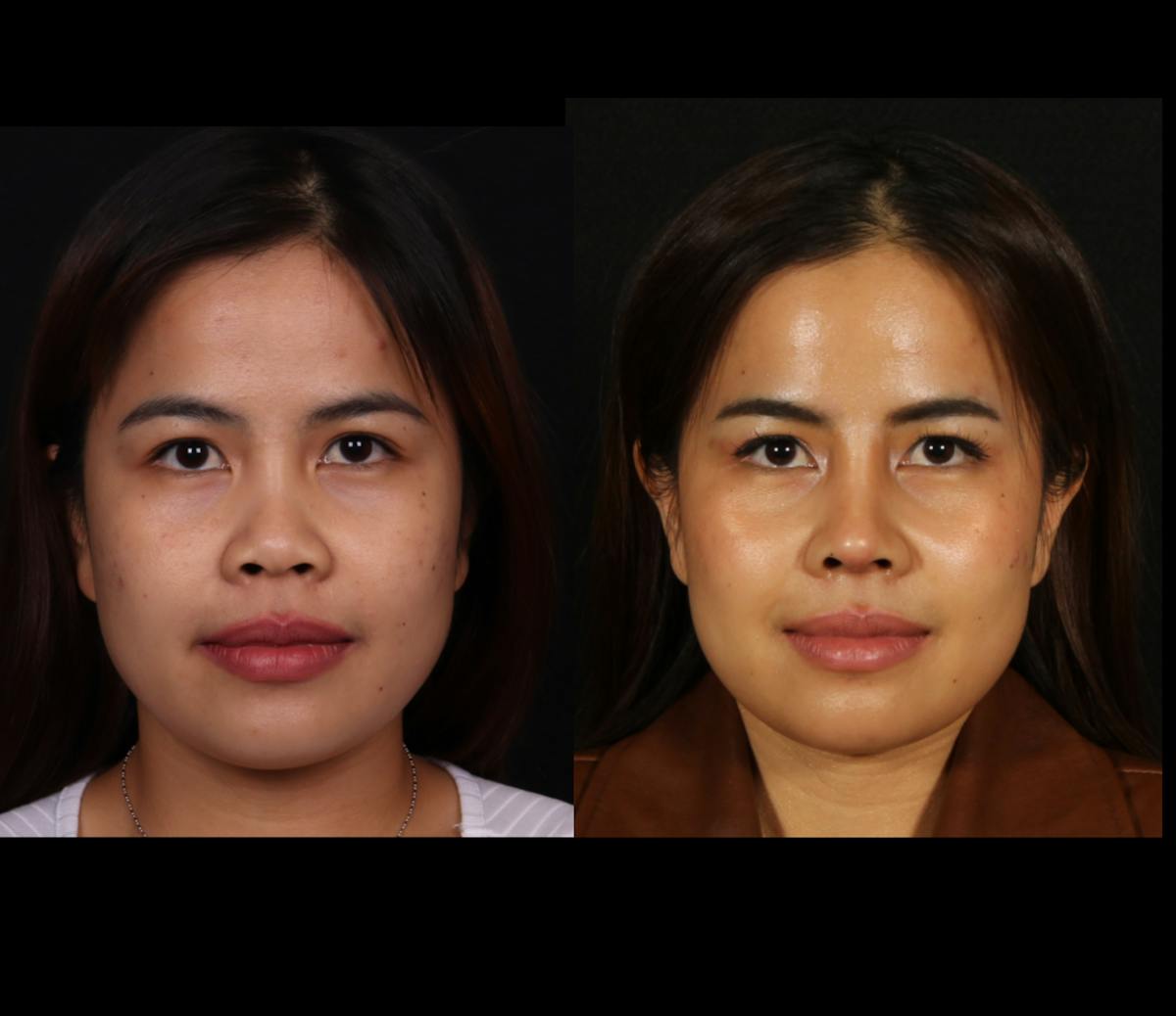 Rhinoplasty Female Before & After Gallery - Patient 417459 - Image 3