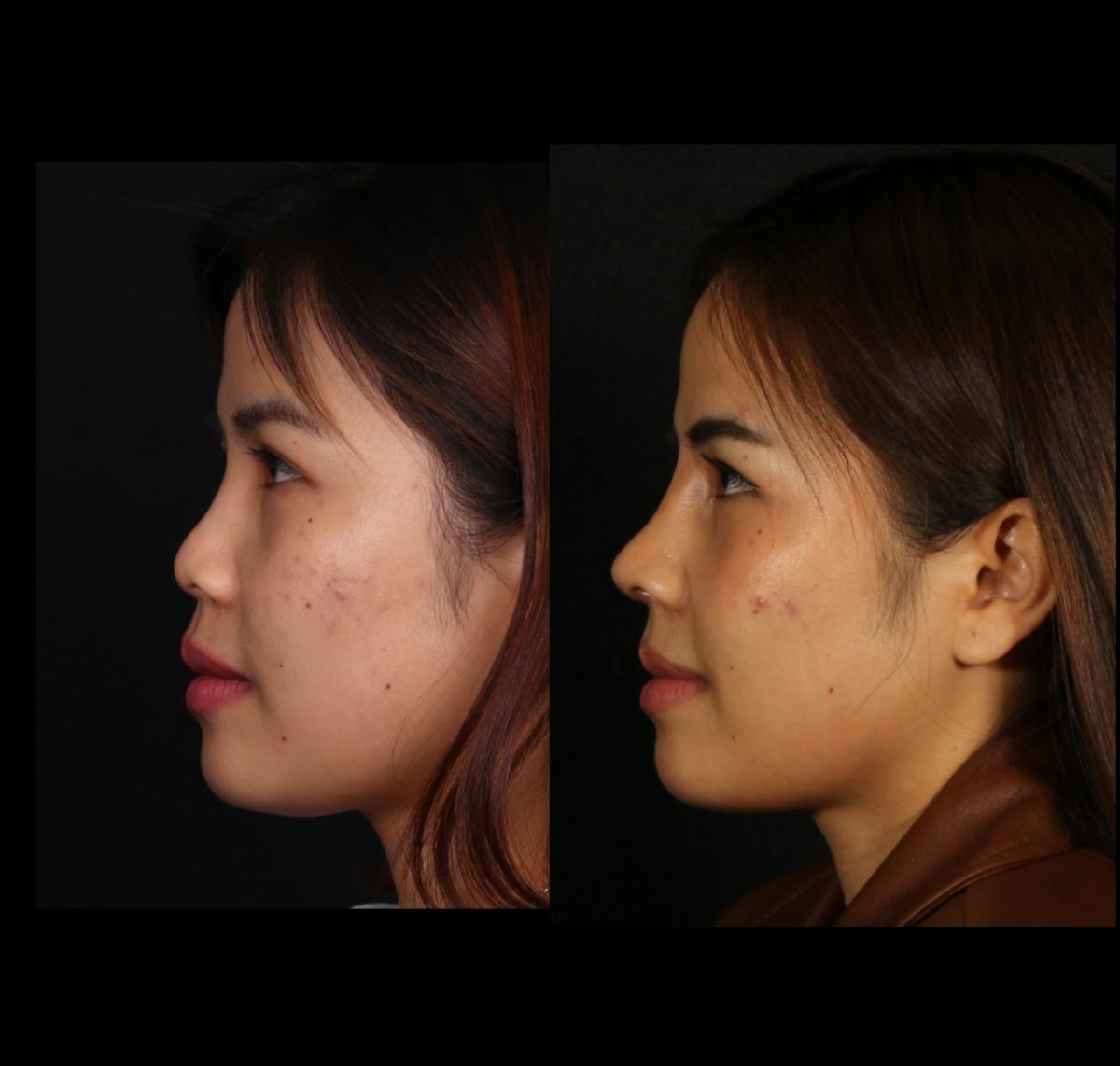 Rhinoplasty Female Before & After Gallery - Patient 417459 - Image 1