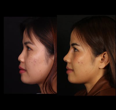 Rhinoplasty Female Before & After Gallery - Patient 417459 - Image 1