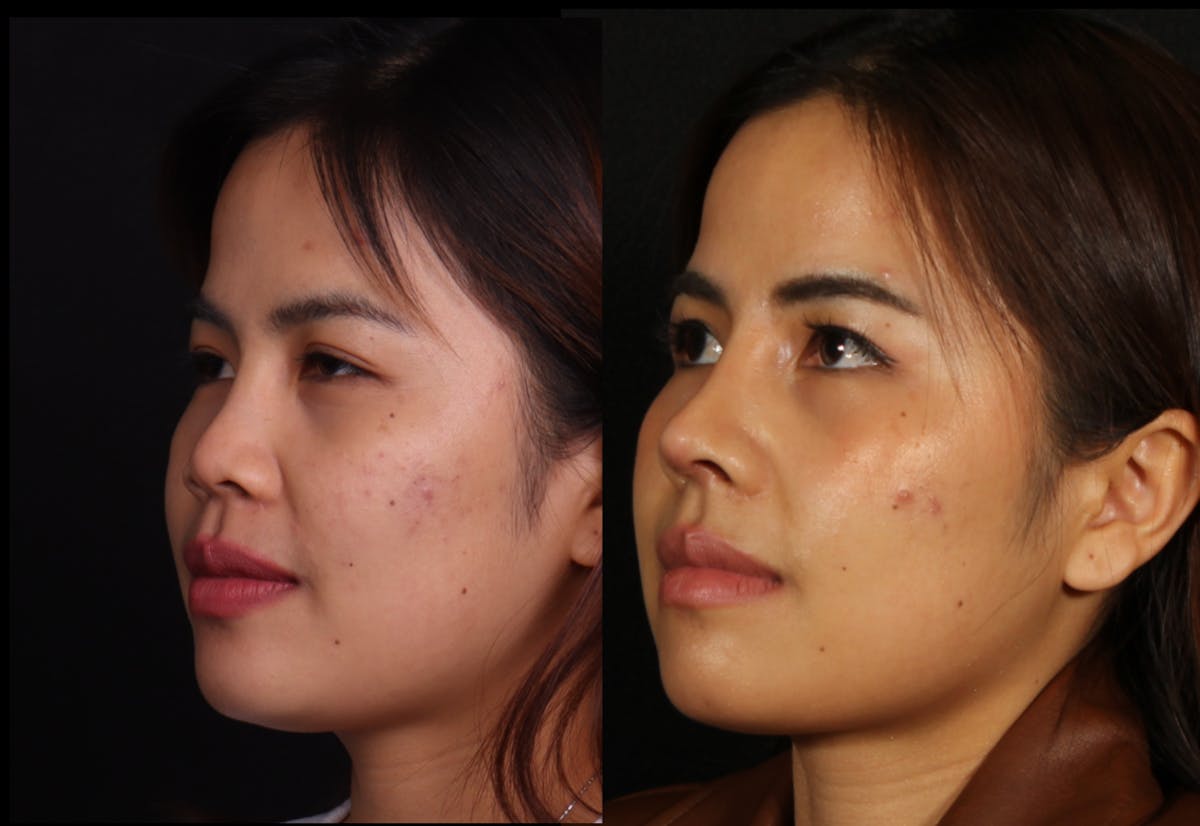 Rhinoplasty Female Before & After Gallery - Patient 417459 - Image 2