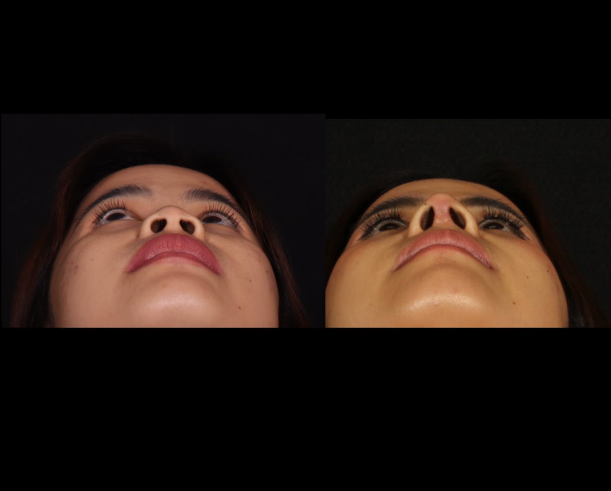 Rhinoplasty Female Before & After Gallery - Patient 417459 - Image 5