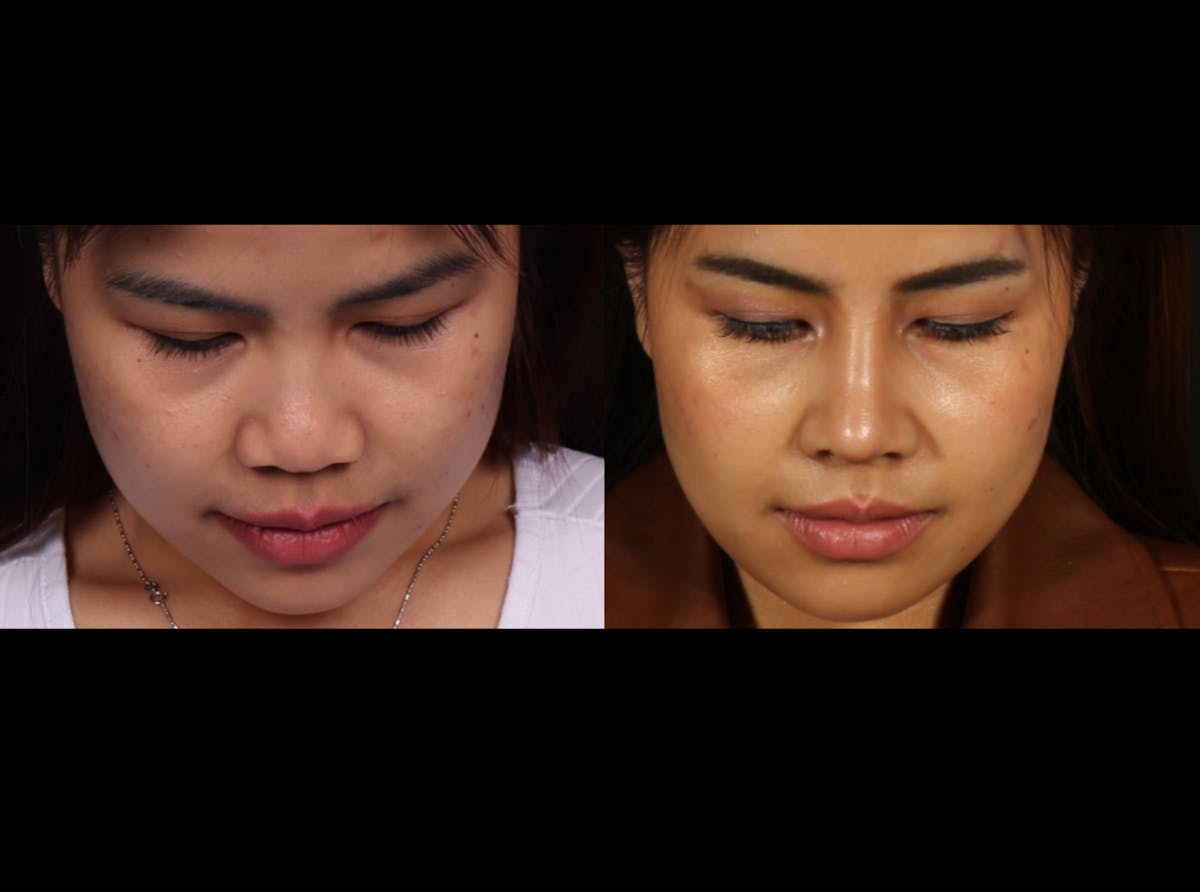 Rhinoplasty Female Before & After Gallery - Patient 417459 - Image 4