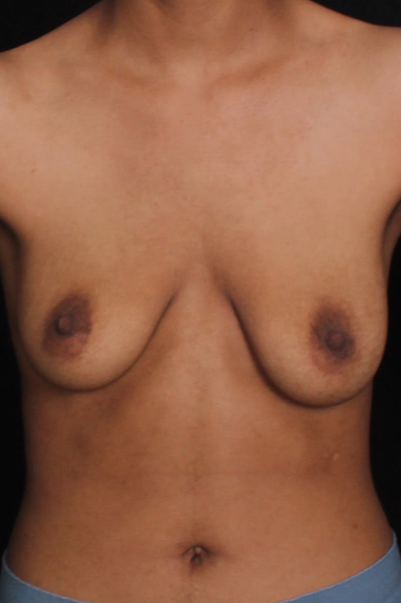 FTM Top Surgery Before & After Gallery - Patient 315485 - Image 1