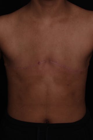 FTM Top Surgery Before & After Gallery - Patient 315485 - Image 2