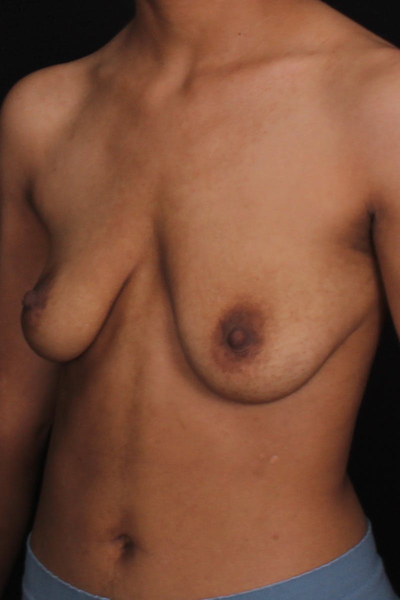 FTM Top Surgery Before & After Gallery - Patient 315485 - Image 3