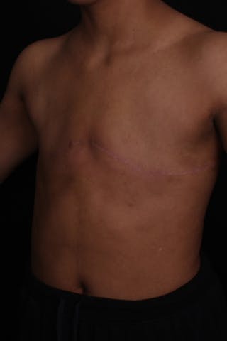 FTM Top Surgery Before & After Gallery - Patient 315485 - Image 4