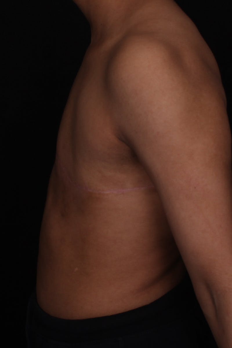 FTM Top Surgery Before & After Gallery - Patient 315485 - Image 6