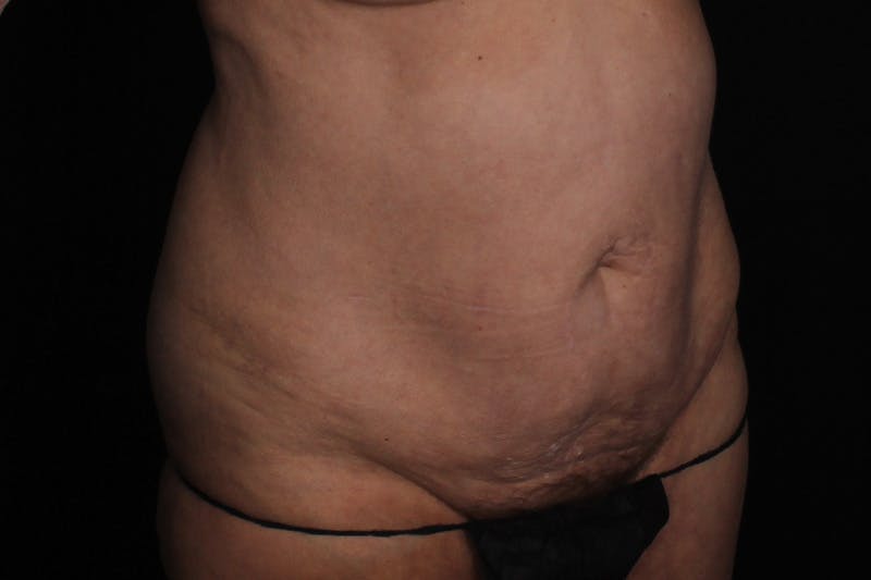 Abdominoplasty Before & After Gallery - Patient 132049 - Image 3