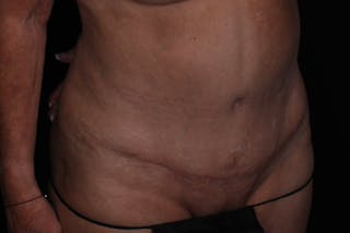 Abdominoplasty Before & After Gallery - Patient 132049 - Image 4