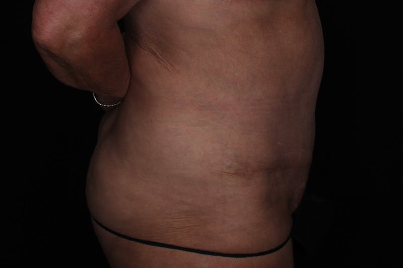 Abdominoplasty Before & After Gallery - Patient 132049 - Image 6