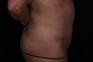 Abdominoplasty Before & After Gallery - Patient 132049 - Image 6