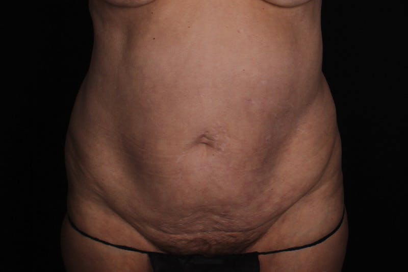 Abdominoplasty Before & After Gallery - Patient 132049 - Image 1