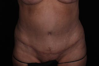 Abdominoplasty Before & After Gallery - Patient 132049 - Image 2