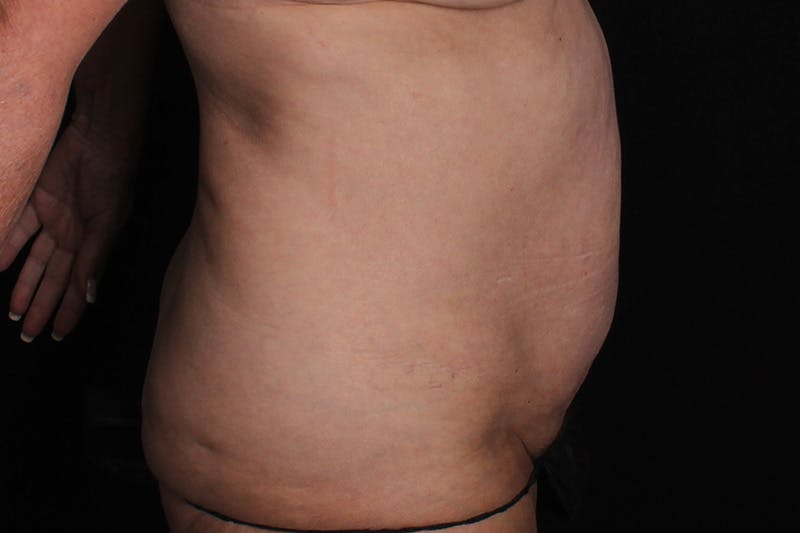 Abdominoplasty Before & After Gallery - Patient 132049 - Image 5