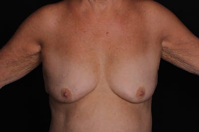 Breast Augmentation with Lift Before & After Gallery - Patient 240921 - Image 1