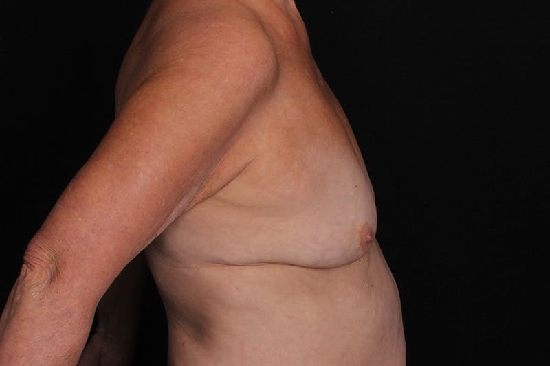 Breast Augmentation with Lift Before & After Gallery - Patient 240921 - Image 5