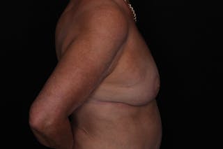 Breast Augmentation with Lift Before & After Gallery - Patient 240921 - Image 6