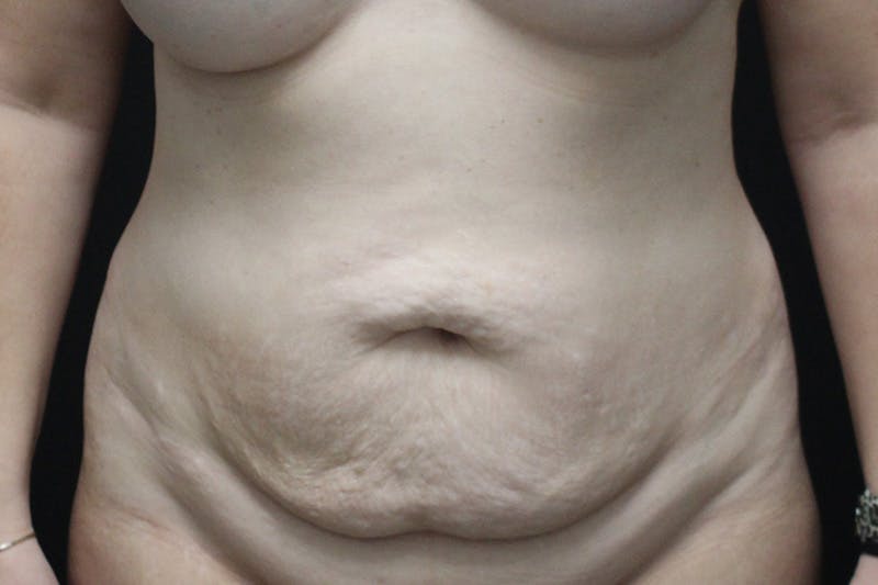 Abdominoplasty Before & After Gallery - Patient 277086 - Image 1