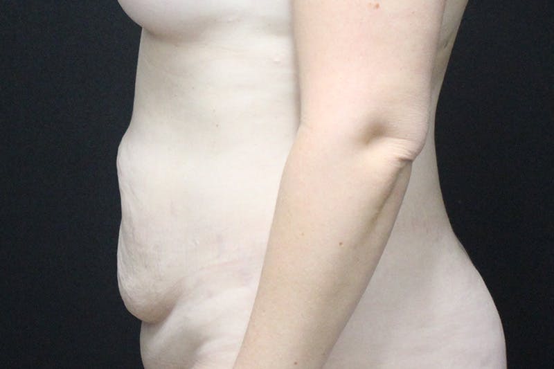 Abdominoplasty Before & After Gallery - Patient 277086 - Image 5