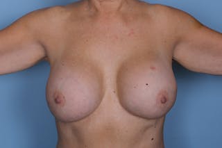 Breast Implant Exchange with Fat Grafting Before & After Gallery - Patient 313612 - Image 2