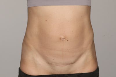 Abdominoplasty Before & After Gallery - Patient 315497 - Image 1