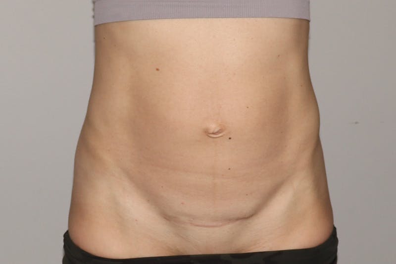 Abdominoplasty Before & After Gallery - Patient 315497 - Image 1