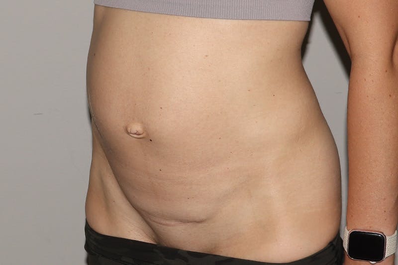Abdominoplasty Before & After Gallery - Patient 315497 - Image 3
