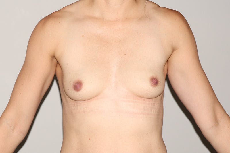 Breast Augmentation Before & After Gallery - Patient 325969 - Image 1