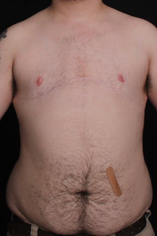 FTM Top Surgery Before & After Gallery - Patient 234267 - Image 2