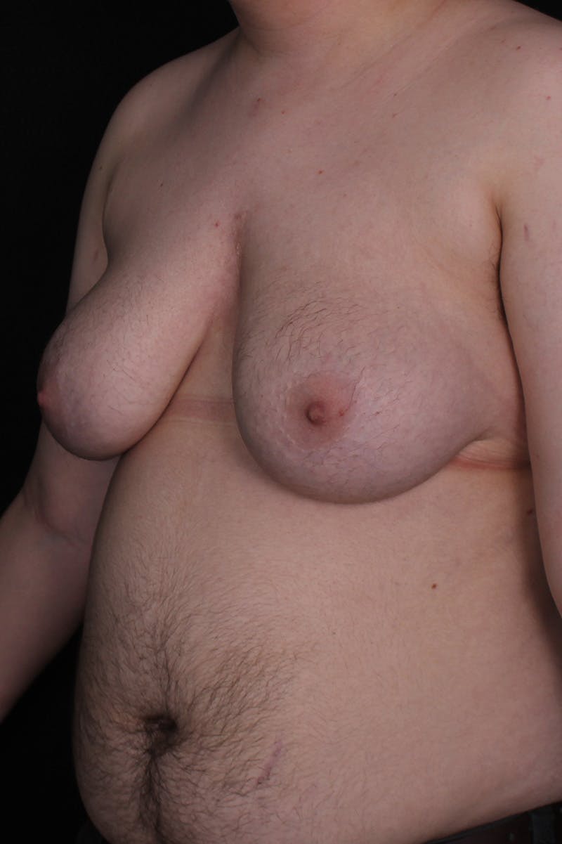 FTM Top Surgery Before & After Gallery - Patient 234267 - Image 3