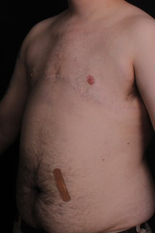 FTM Top Surgery Before & After Gallery - Patient 234267 - Image 4