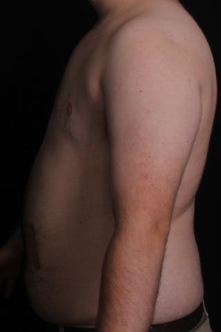 FTM Top Surgery Before & After Gallery - Patient 234267 - Image 6